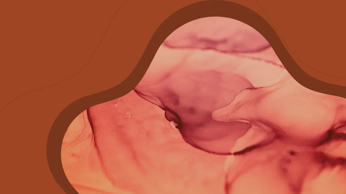 Endometriosis and Pregnancy