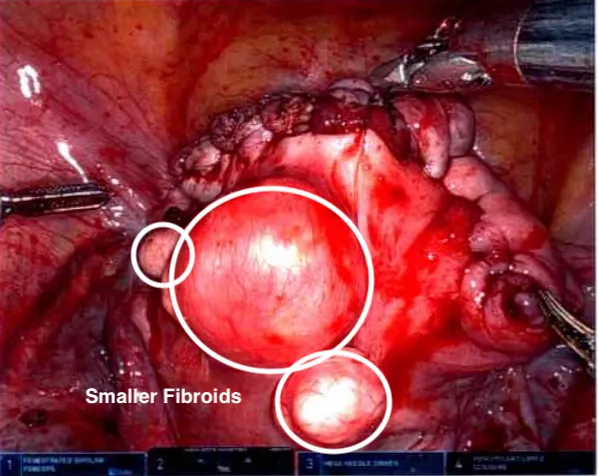 View of the uterus after removal of the dominant fibroid, with remaining smaller subserosal fibroids visible