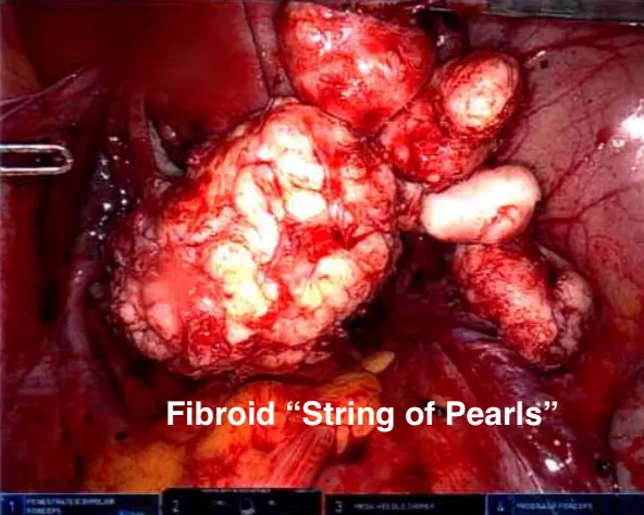 Ten smaller fibroids collected on a suture after removal from the uterus