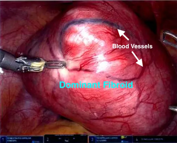 Initial laparoscopic view of the pelvis showing the dominant 16cm fibroid filling the surgical field