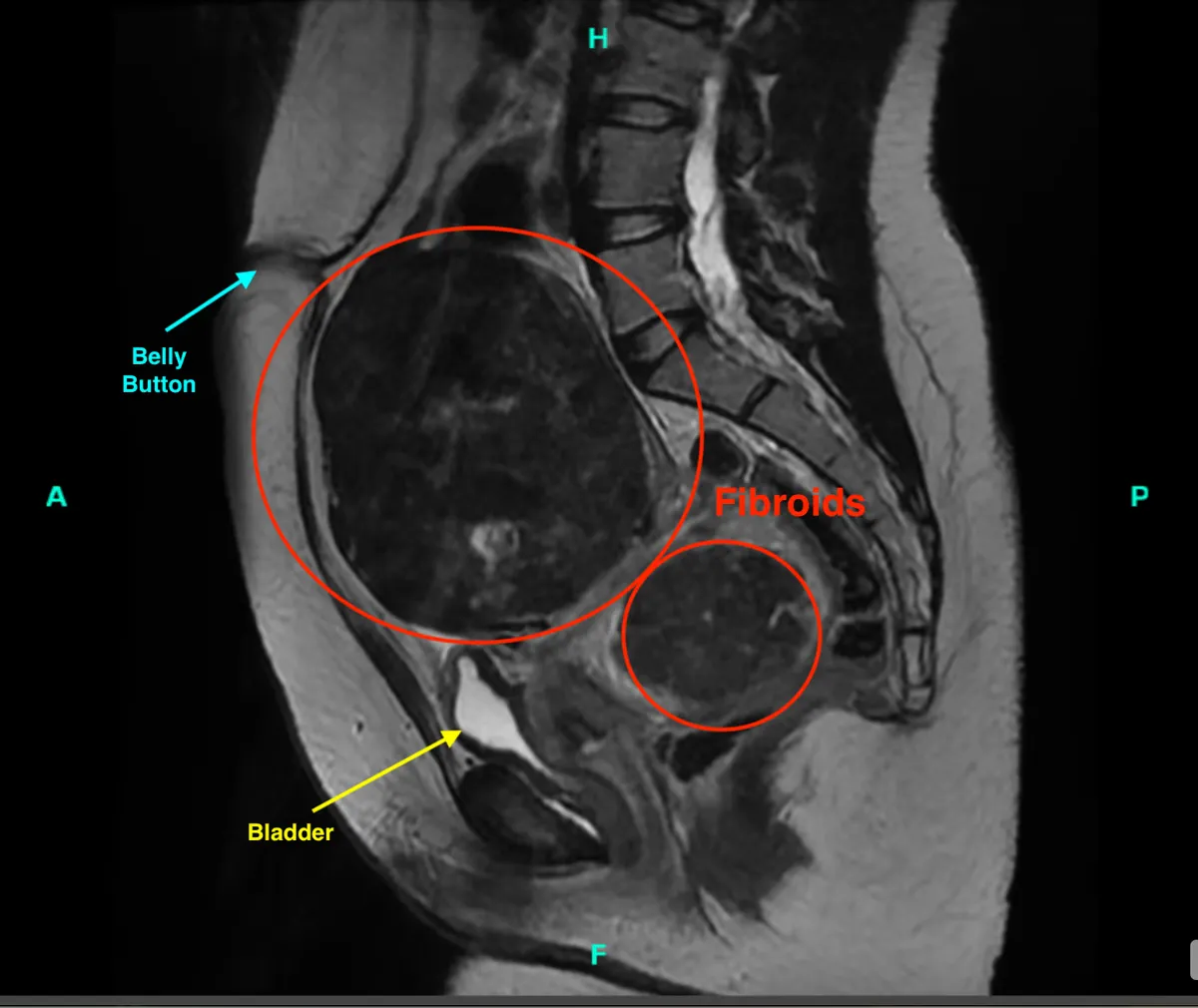 Preoperative MRI showing the dominant fibroid reaching the level of the umbilicus along with several smaller fibroids